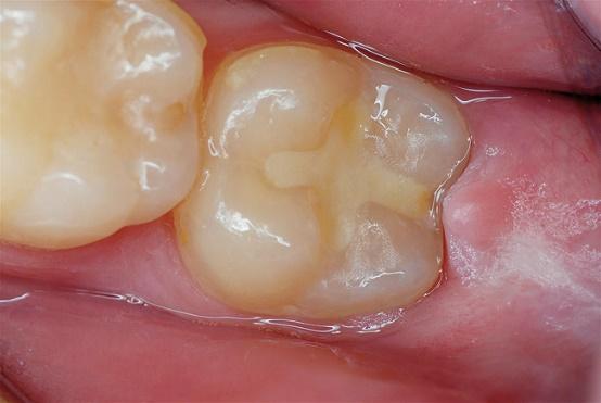 hasil-gambar-untuk-gic-dental.jpeg